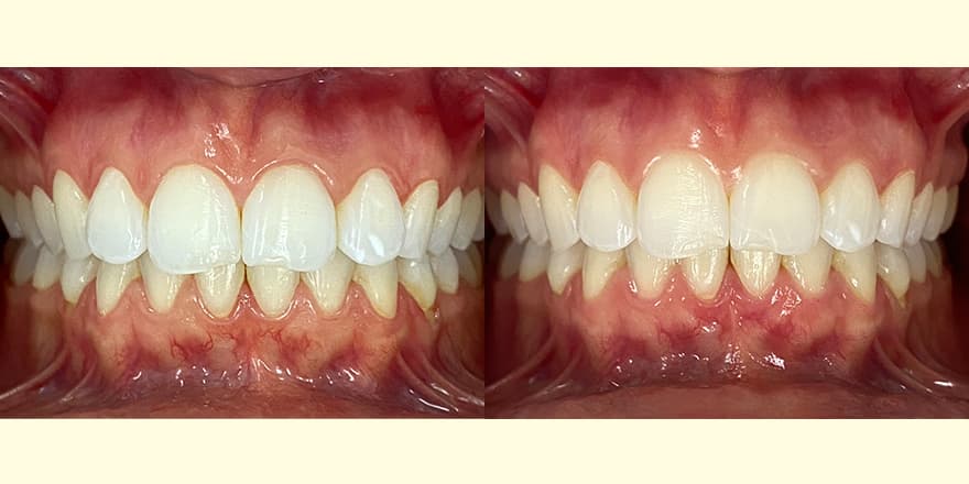 Antes e depois de um cliente que realizou tratamento com a SouSmile