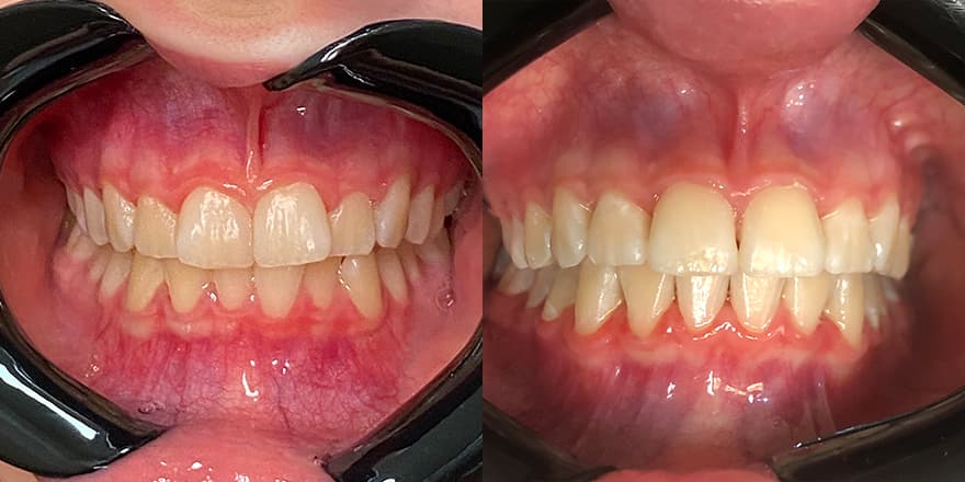 Antes e depois de um cliente que realizou tratamento com a SouSmile