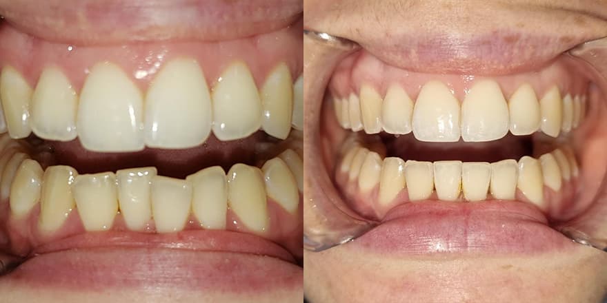 Antes e depois de um cliente que realizou tratamento com a SouSmile