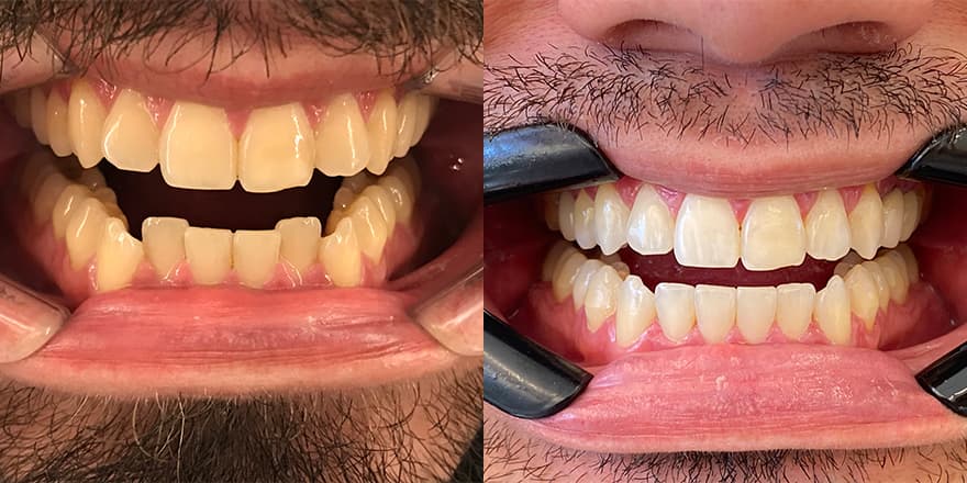 Antes e depois de um cliente que realizou tratamento com a SouSmile