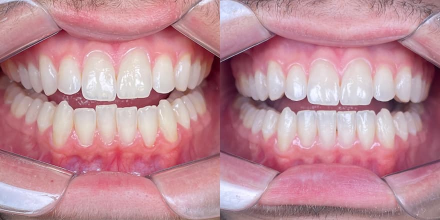 Antes e depois de um cliente que realizou tratamento com a SouSmile