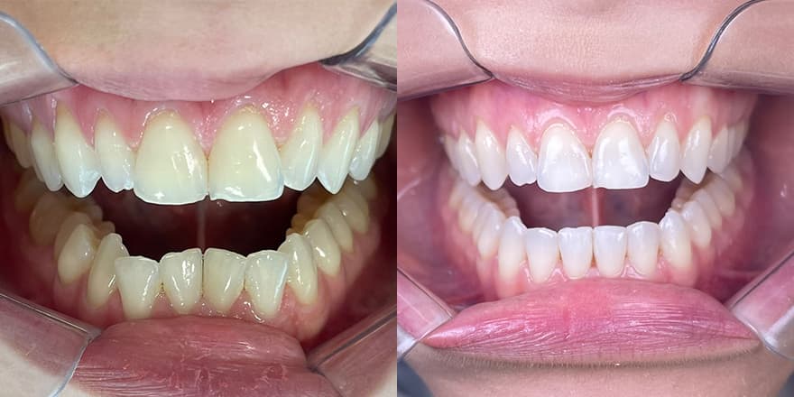 Antes e depois de um cliente que realizou tratamento com a SouSmile