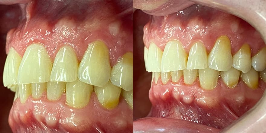 Antes e depois de um cliente que realizou tratamento com a SouSmile