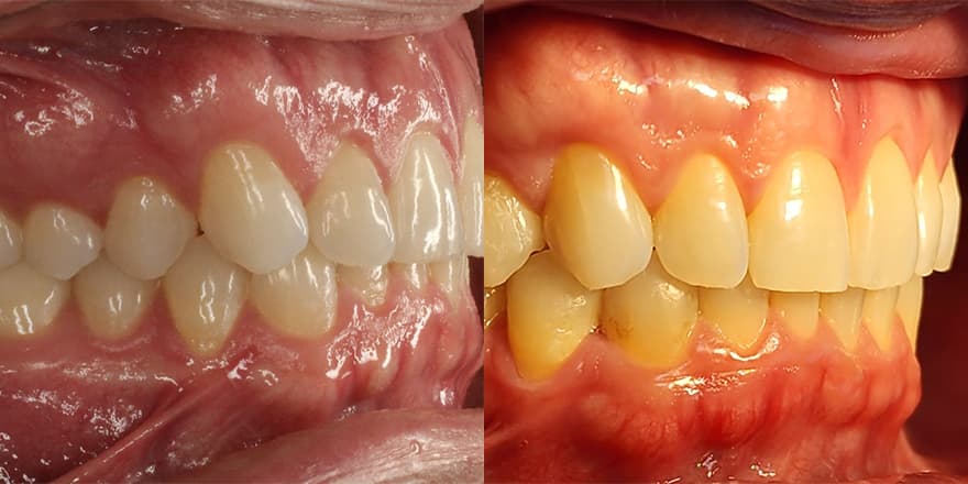 Antes e depois de um cliente que realizou tratamento com a SouSmile