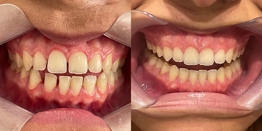 Antes e depois de um cliente que realizou tratamento com a SouSmile