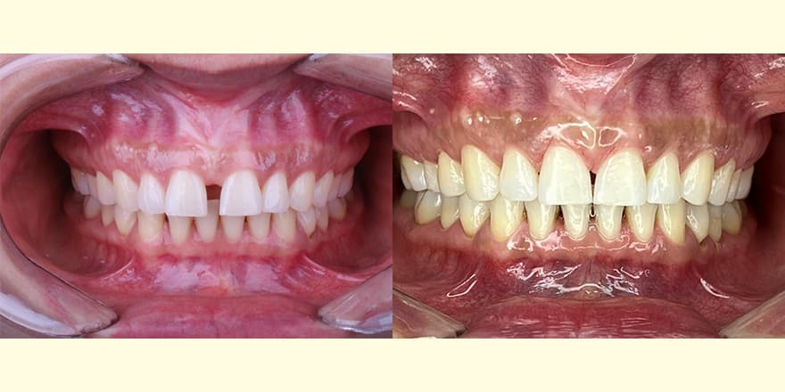 Antes e depois de um cliente que realizou tratamento com a SouSmile