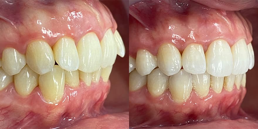 Antes e depois de um cliente que realizou tratamento com a SouSmile