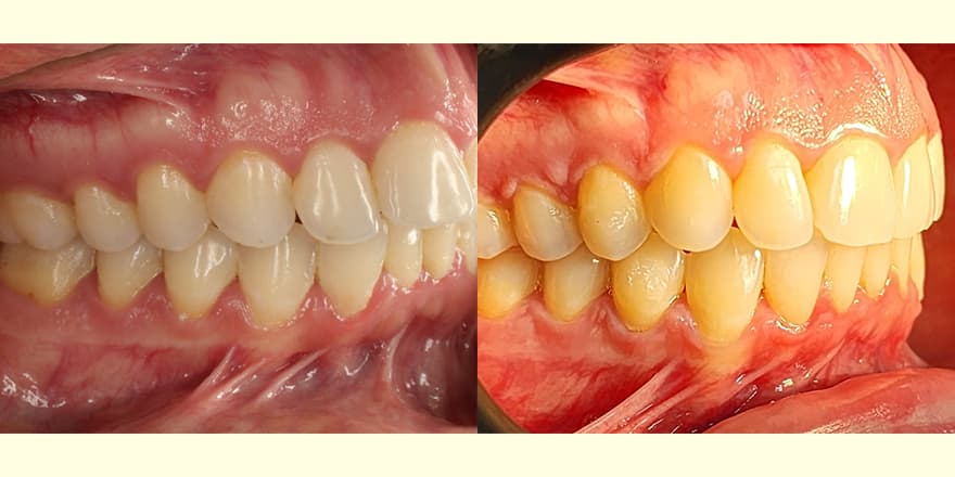 Antes e depois de um cliente que realizou tratamento com a SouSmile