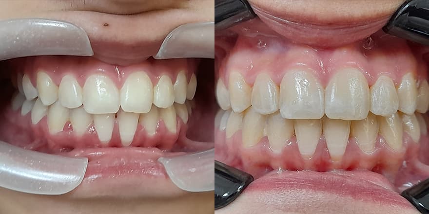 Antes e depois de um cliente que realizou tratamento com a SouSmile