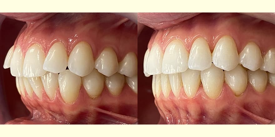 Antes e depois de um cliente que realizou tratamento com a SouSmile
