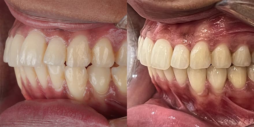 Antes e depois de um cliente que realizou tratamento com a SouSmile