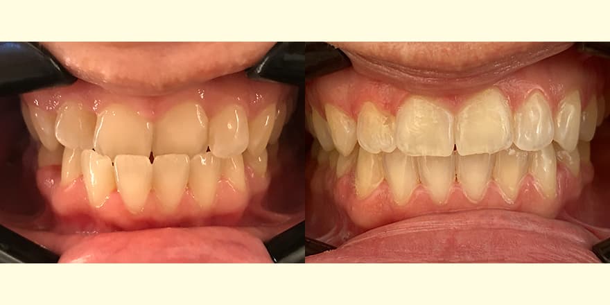 Antes e depois de um cliente que realizou tratamento com a SouSmile