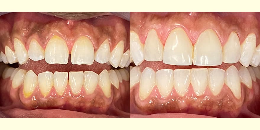 Antes e depois de um cliente que realizou tratamento com a SouSmile