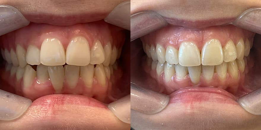 Antes e depois de um cliente que realizou tratamento com a SouSmile