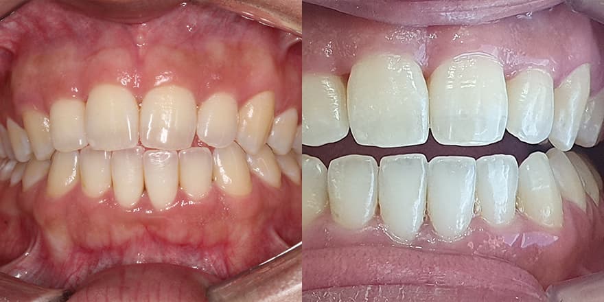 Antes e depois de um cliente que realizou tratamento com a SouSmile