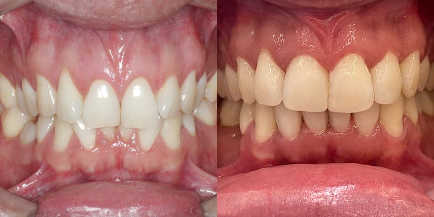 Antes e depois de um cliente que realizou tratamento com a SouSmile