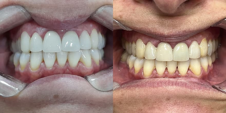 Antes e depois de um cliente que realizou tratamento com a SouSmile