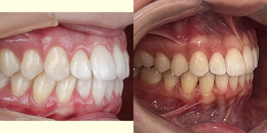 Antes e depois de um cliente que realizou tratamento com a SouSmile