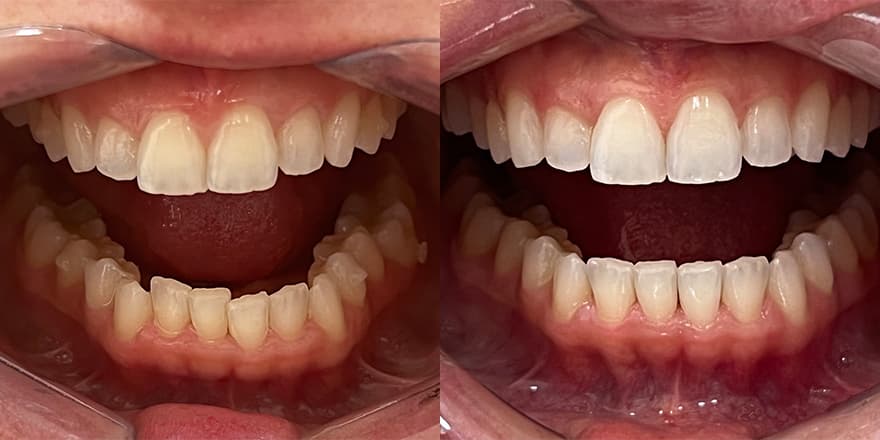 Antes e depois de um cliente que realizou tratamento com a SouSmile