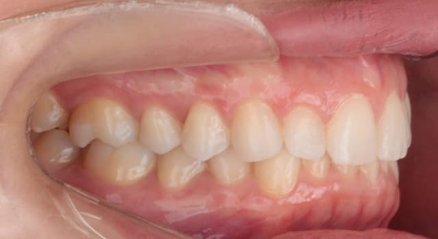 Antes e depois de um cliente que realizou tratamento com a SouSmile