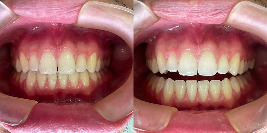 Antes e depois de um cliente que realizou tratamento com a SouSmile