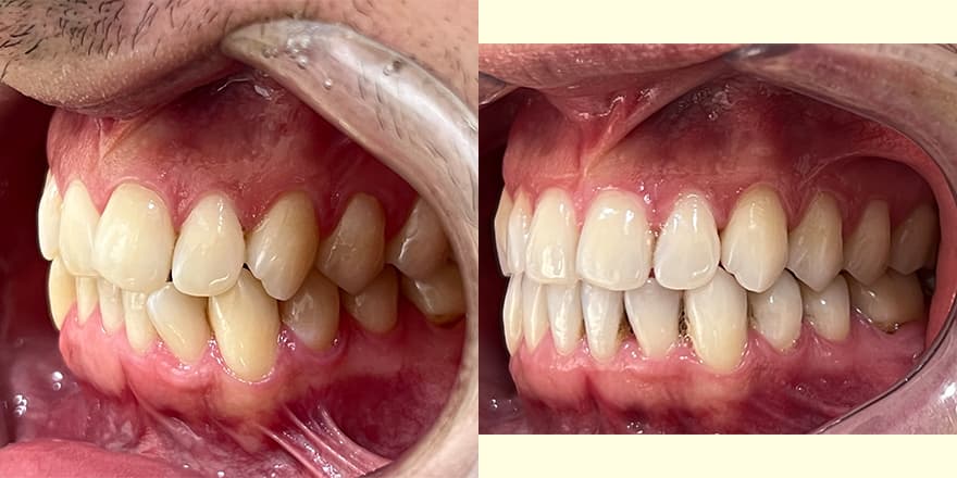 Antes e depois de um cliente que realizou tratamento com a SouSmile