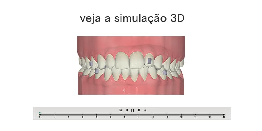 Simulação do tratamento com a SouSmile