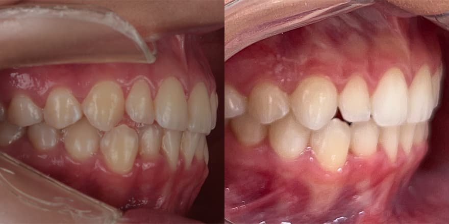 Antes e depois de um cliente que realizou tratamento com a SouSmile