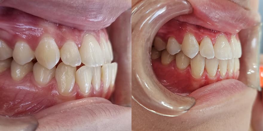 Antes e depois de um cliente que realizou tratamento com a SouSmile