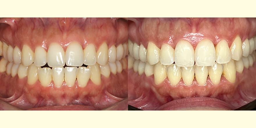 Antes e depois de um cliente que realizou tratamento com a SouSmile