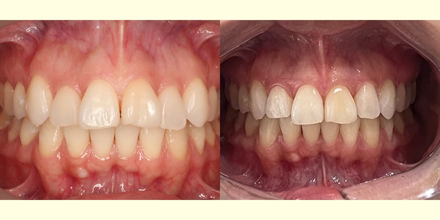 Antes e depois de um cliente que realizou tratamento com a SouSmile