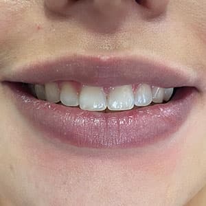 Dentes de cliente SouSmile após o uso do aparelho invisível