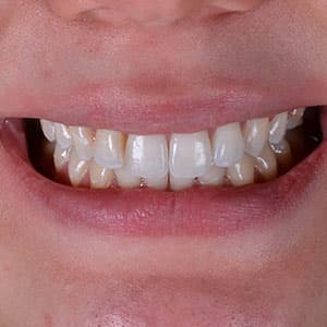 Dentes de cliente SouSmile após o uso do aparelho invisível
