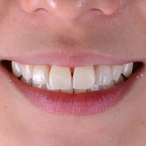 Dentes de cliente SouSmile após o uso do aparelho invisível