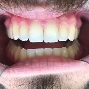 Dentes de cliente SouSmile após o uso do aparelho invisível