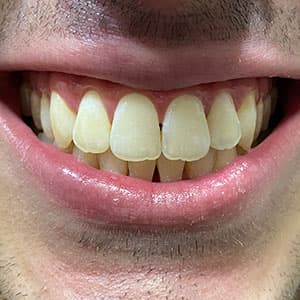 Dentes de cliente SouSmile após o uso do aparelho invisível