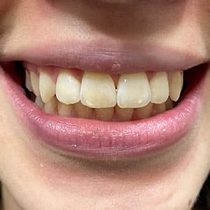 Dentes de cliente SouSmile após o uso do aparelho invisível