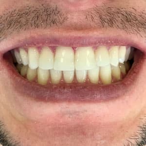 Dentes de cliente SouSmile após o uso do aparelho invisível