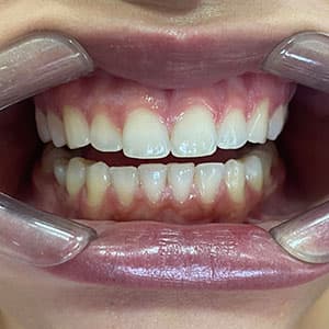 Dentes de cliente SouSmile após o uso do aparelho invisível