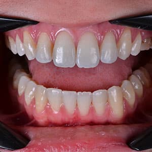 Dentes de cliente SouSmile após o uso do aparelho invisível