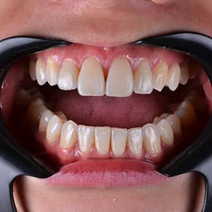 Dentes de cliente SouSmile após o uso do aparelho invisível