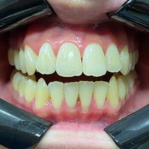 Dentes de cliente SouSmile após o uso do aparelho invisível