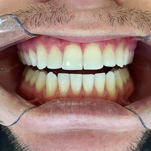Dentes de cliente SouSmile após o uso do aparelho invisível