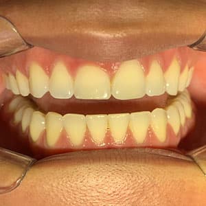 Dentes de cliente SouSmile após o uso do aparelho invisível
