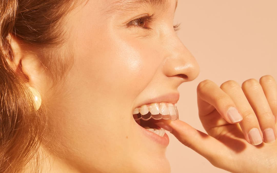mulher sorrindo com o aparelho invisível SouSmile