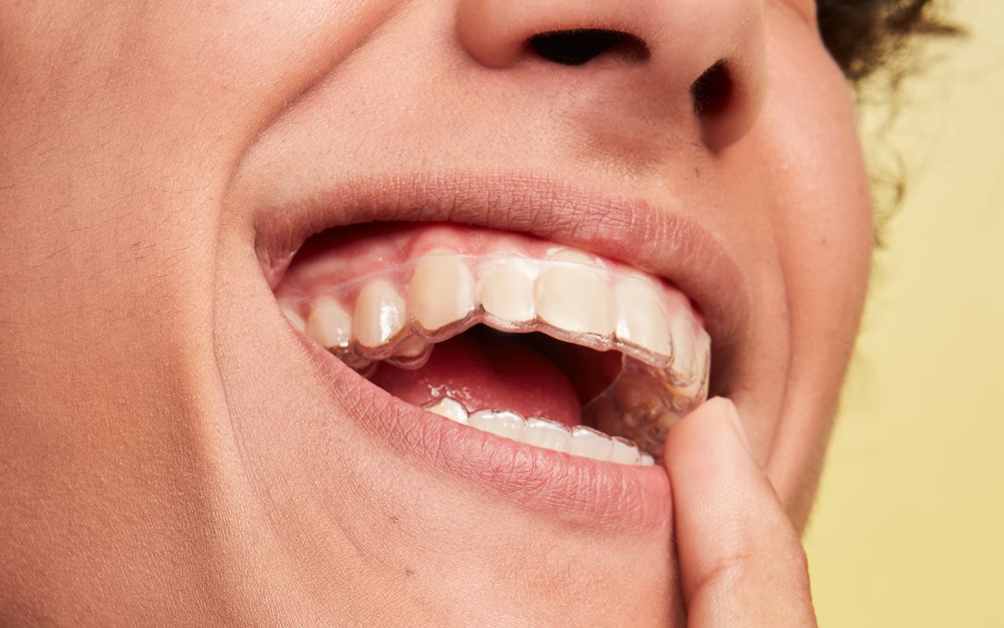 homem sorrindo com o aparelho invisível SouSmile