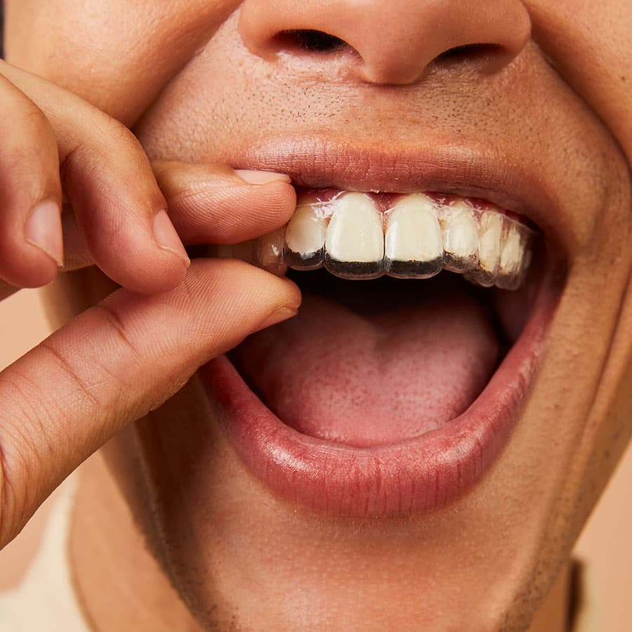 como-funciona-o-aparelho-dental-transparente