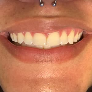 Cliente após o uso do aparelho invisível SouSmile