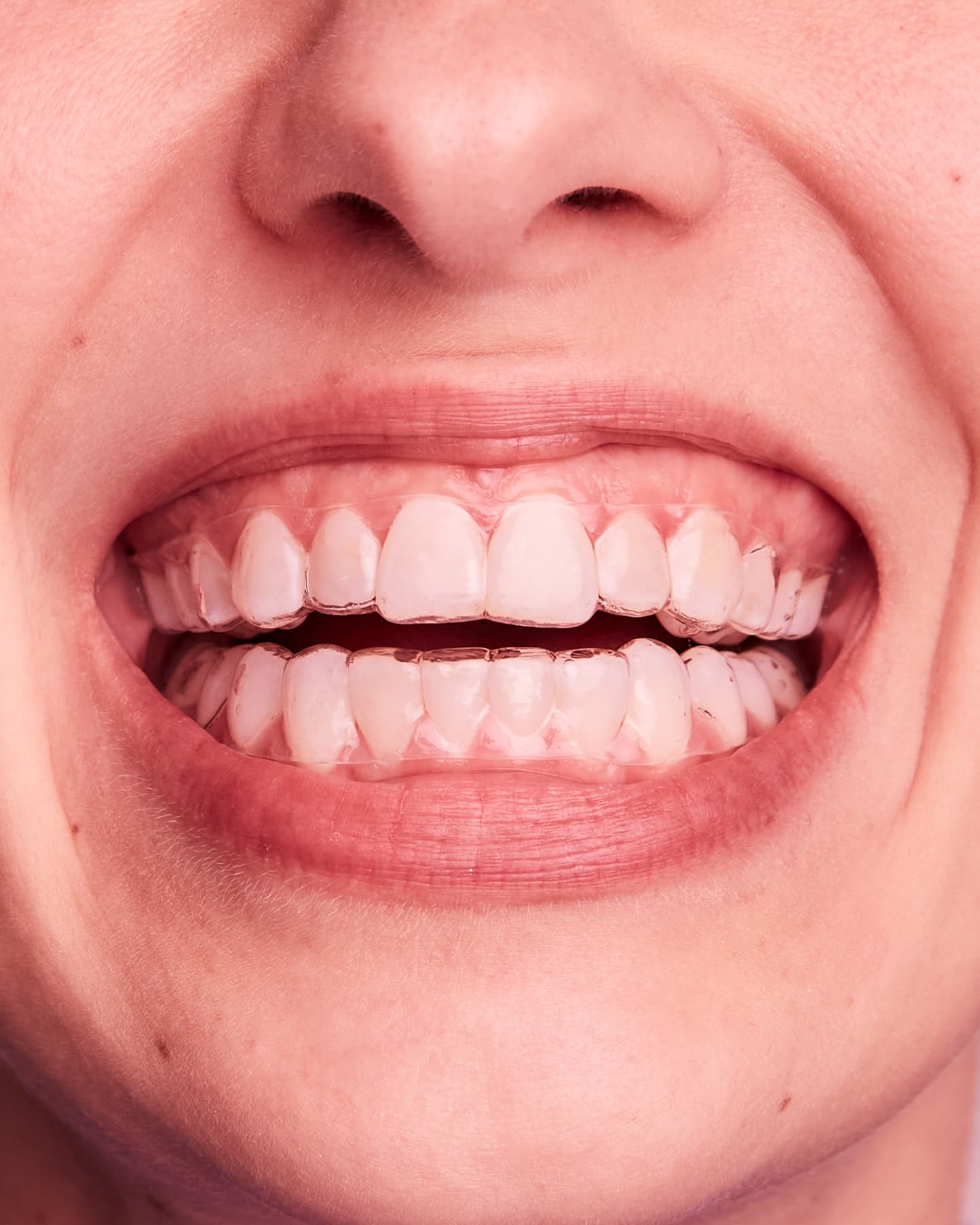 clareamento dental associação de técnicas sousmile