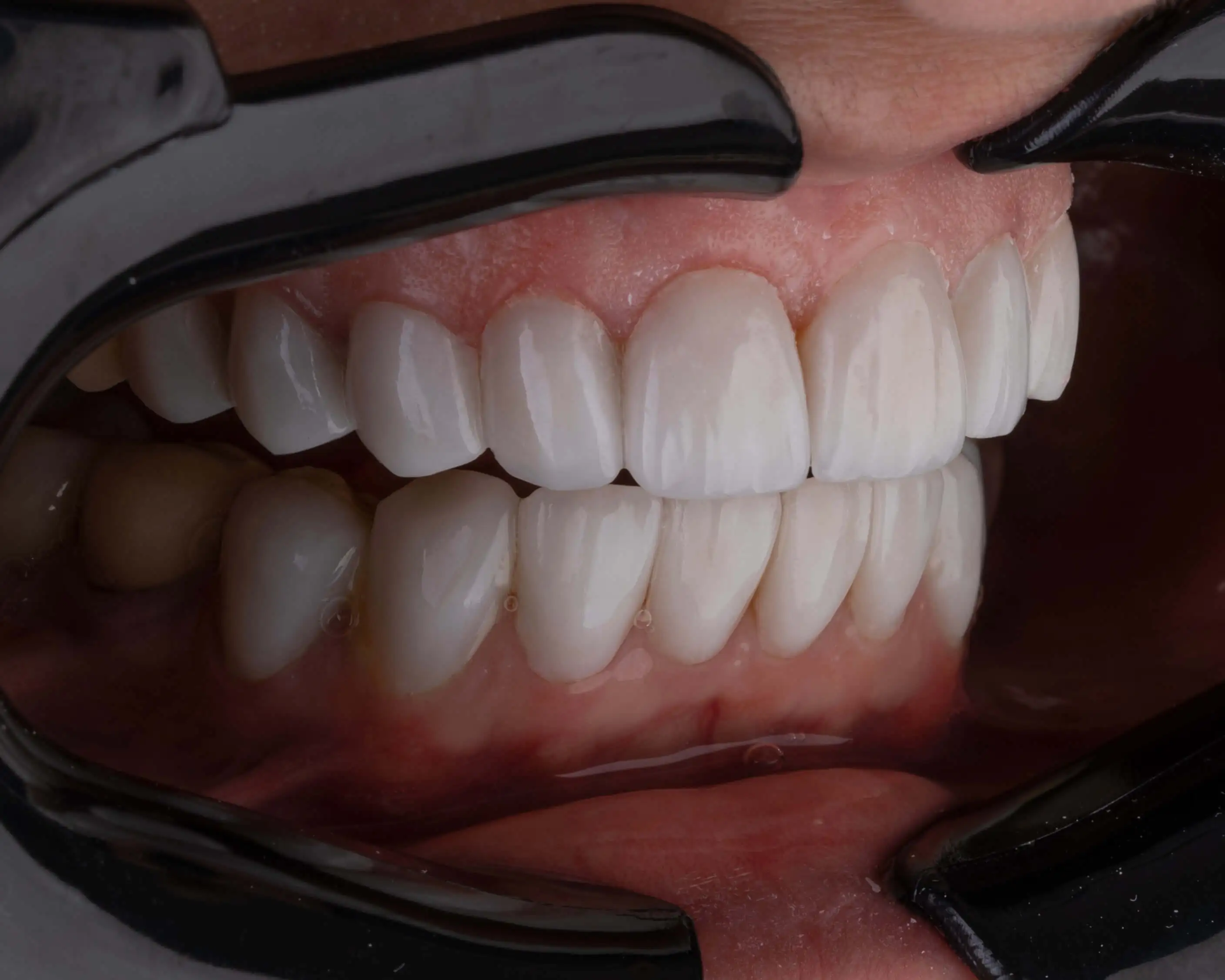 clareamento dental